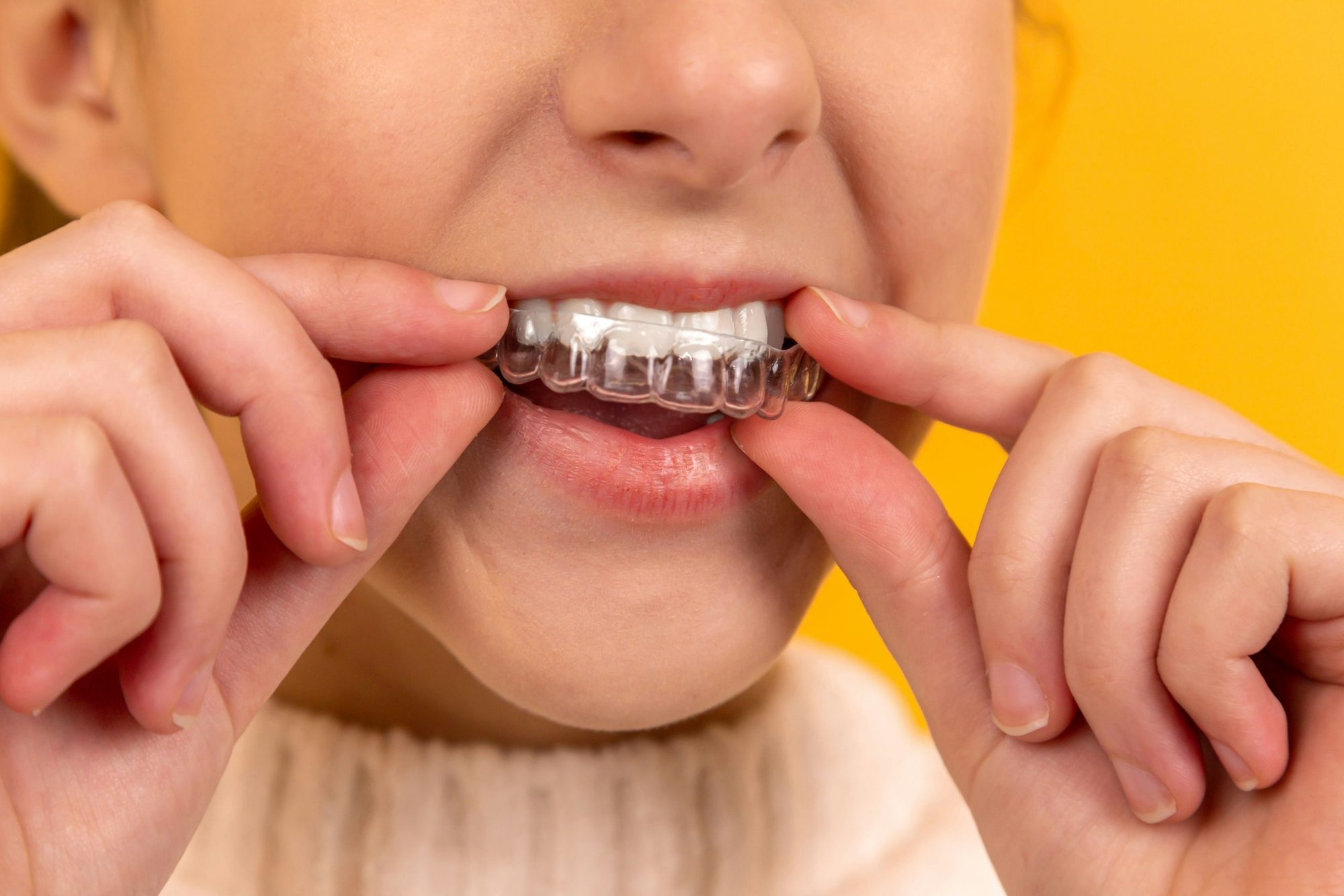 A woman fitting a clear whitening tray over her teeth